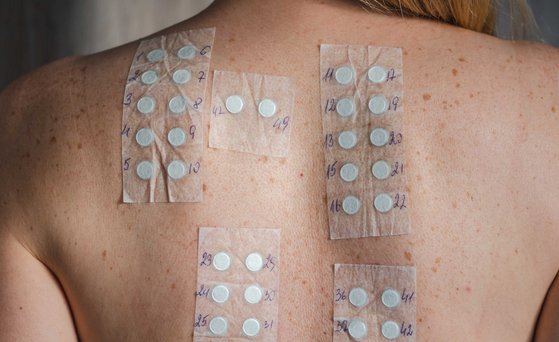 Allergien Nacken und Rücken einer Frau mit Allergietest beklebt.