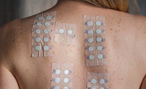 Allergien Neck and back of a female person with allergy test strips
