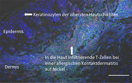 Abbildung 1: Allergische Kontaktdermatitis